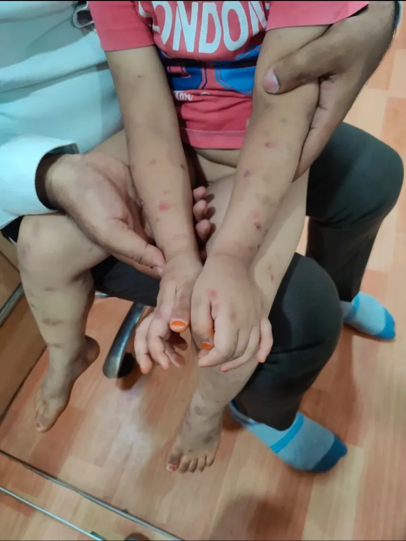 Psoriasis on the arms and legs of a young child