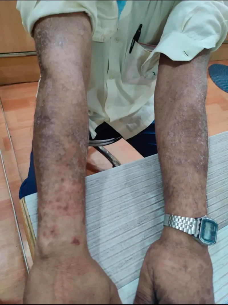 Psoriasis plaques covering both forearms of an adult patient