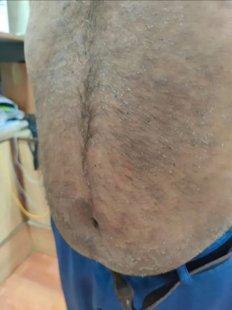 Dry, scaling psoriasis across the abdomen of an adult patient