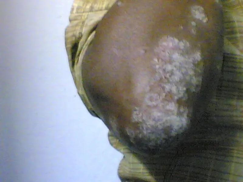A raised, silvery psoriasis plaque on an adult patient's shoulder