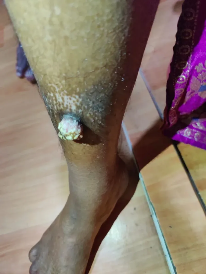 A thickened psoriasis lesion on the lower leg with scaling around it